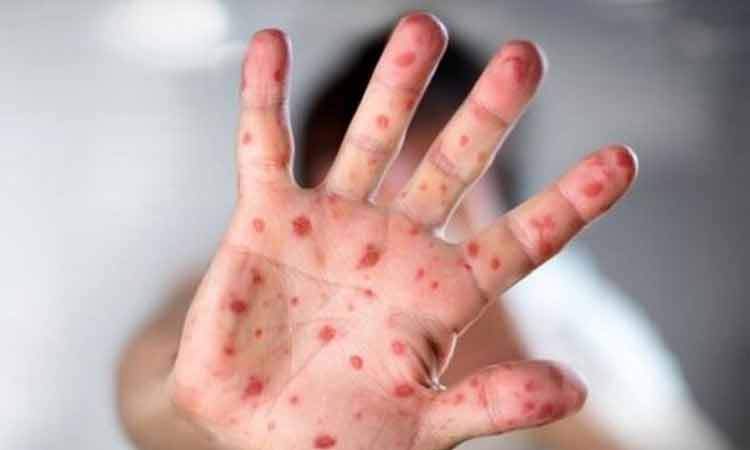 اتباع افغانستانی و پاکستانی عامل شیوع سرخک در ایران