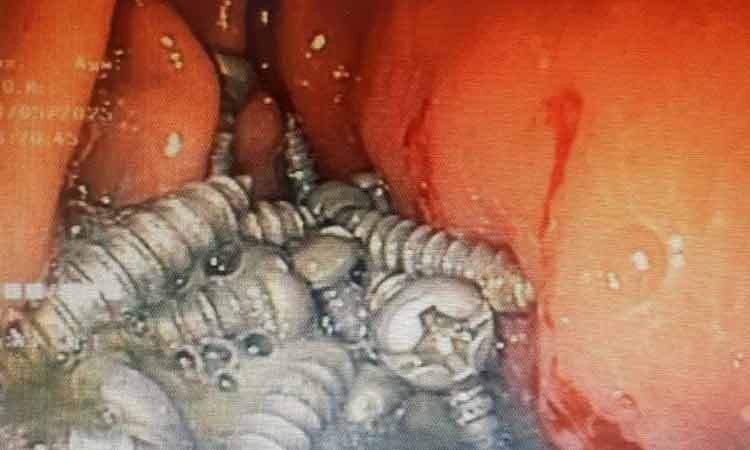 خارج کردن ۴۷ پیچ از معده یک بیمار!