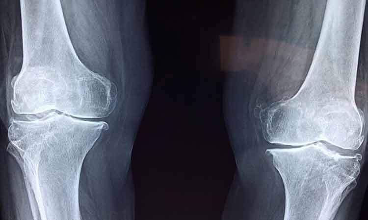 تشخیص علائم اولیه پوکی استخوان با هوش مصنوعی