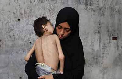 هشدار آنروا: سوء تغذیه کودکان غزه شدت گرفته است